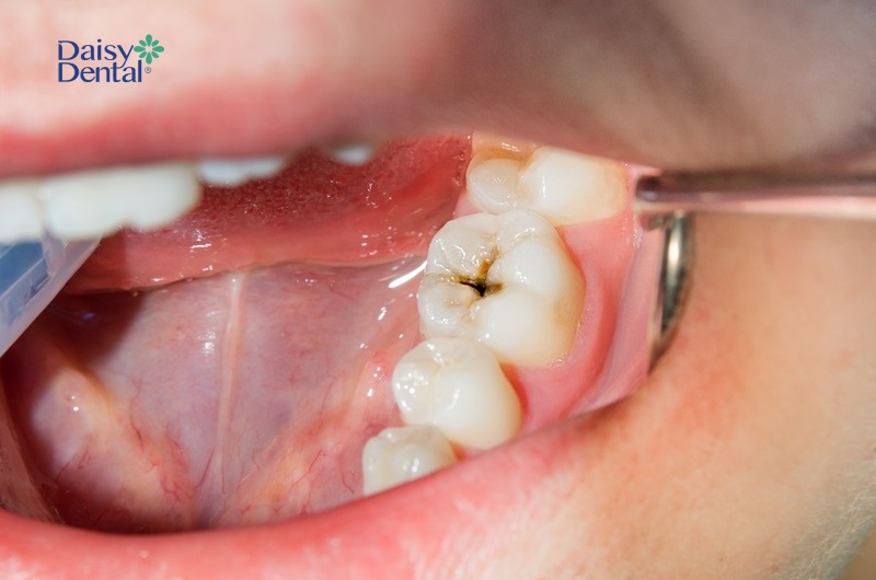 Tùy thuộc vào tình trạng sâu răng mà nha sĩ sẽ chỉ định cách khắc phục khác nhau