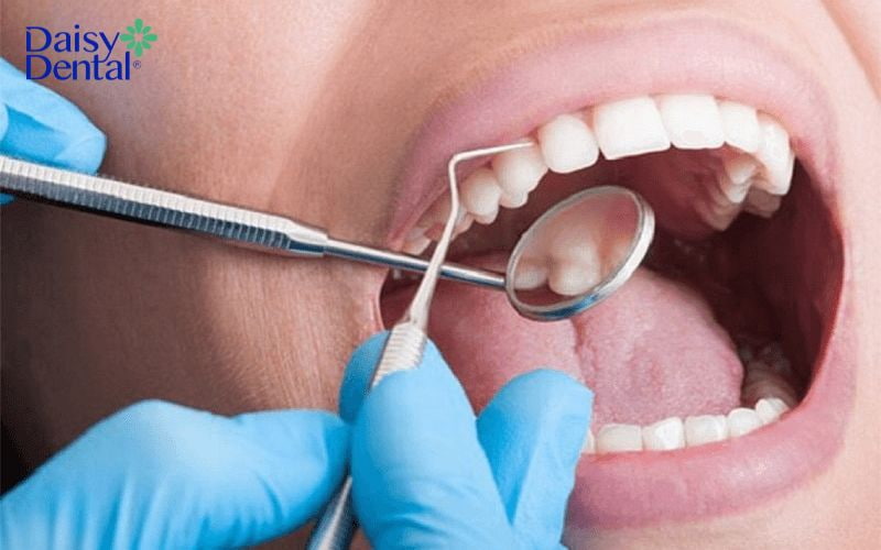 Lấy cao răng định kỳ để tránh bị sưng mộng răng