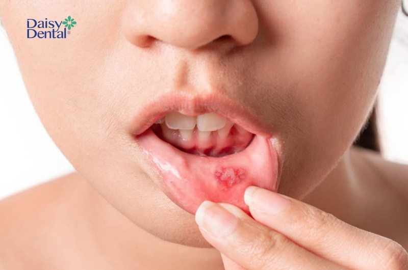 Nhiệt miệng xuất hiện ở nhiều độ tuổi khác nhau, từ trẻ nhỏ đến người lớn tuổi