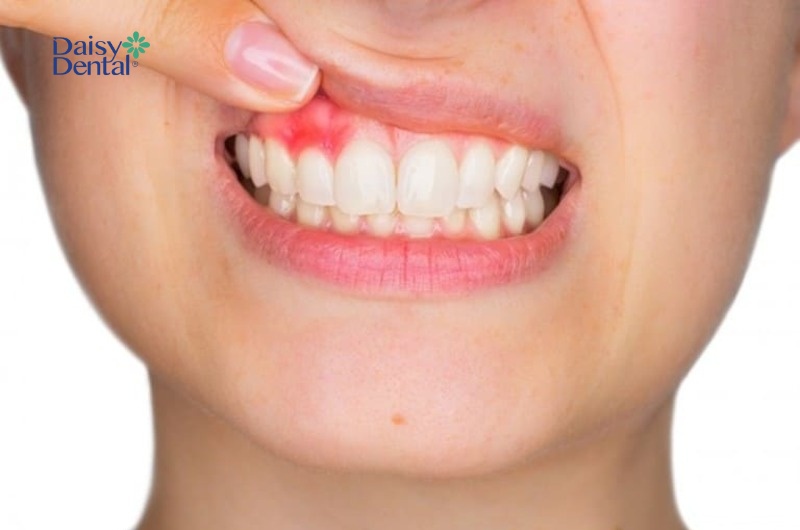 Mắc một số bệnh lý răng miệng kéo dài cũng khiến nhiệt miệng liên tục tái phát