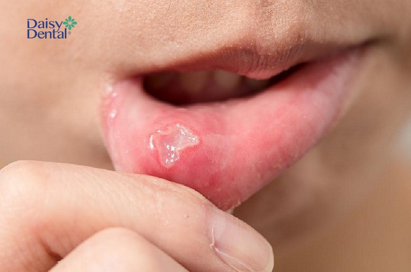 Nhiệt miệng có các vết loét đặc trưng tại môi, má trong