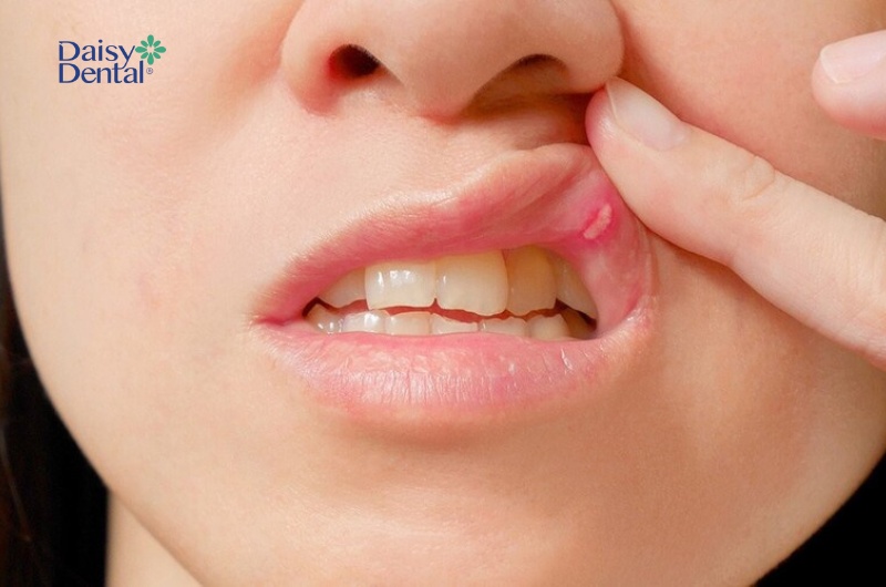 Tuy là bệnh lý nhẹ nhưng nhiệt miệng tái phát liên tục cũng có khả năng báo hiệu các bệnh phức tạp khác