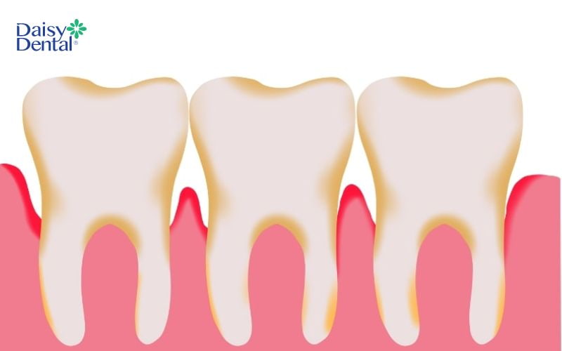 Những người bị viêm nha chu thường bị sưng nướu răng