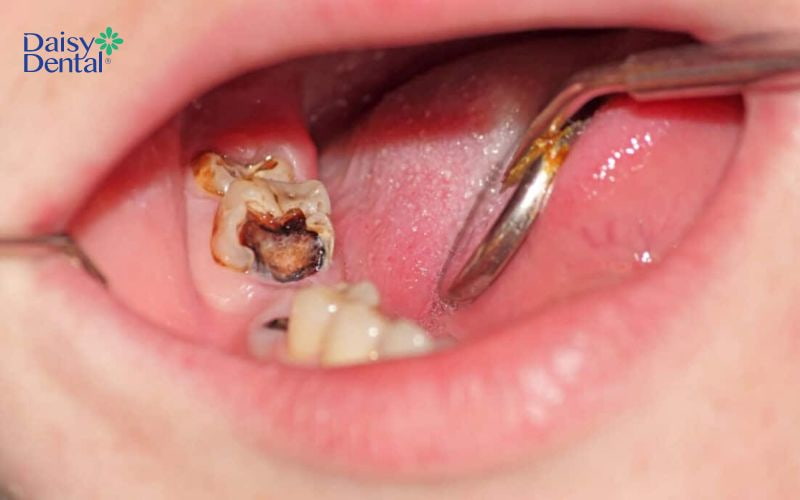 Sâu răng nghiêm trọng có thể ảnh hưởng đến nướu răng