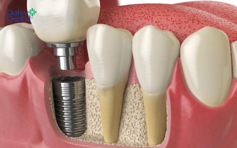 Trồng răng Implant giúp hạn chế tình trạng tiêu xương hàm