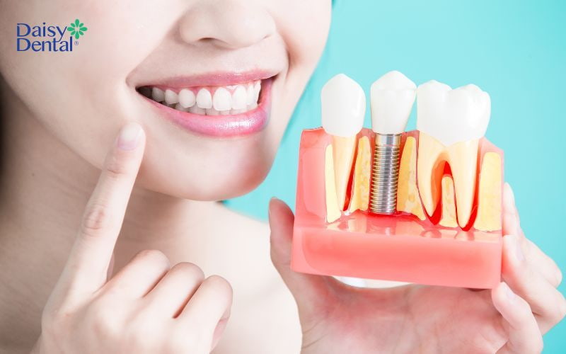 Trồng răng Implant giúp duy trì thẩm mỹ cho khuôn mặt
