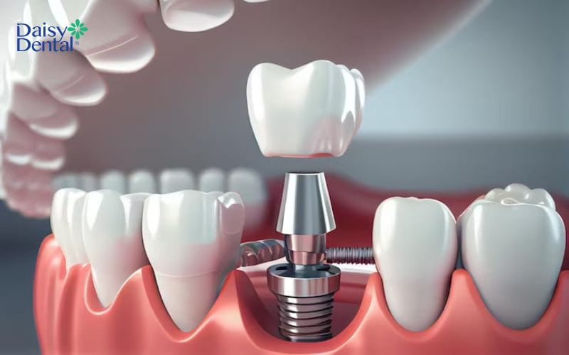 Trồng Implant giúp hạn chế sự ảnh hưởng của các răng kế cận