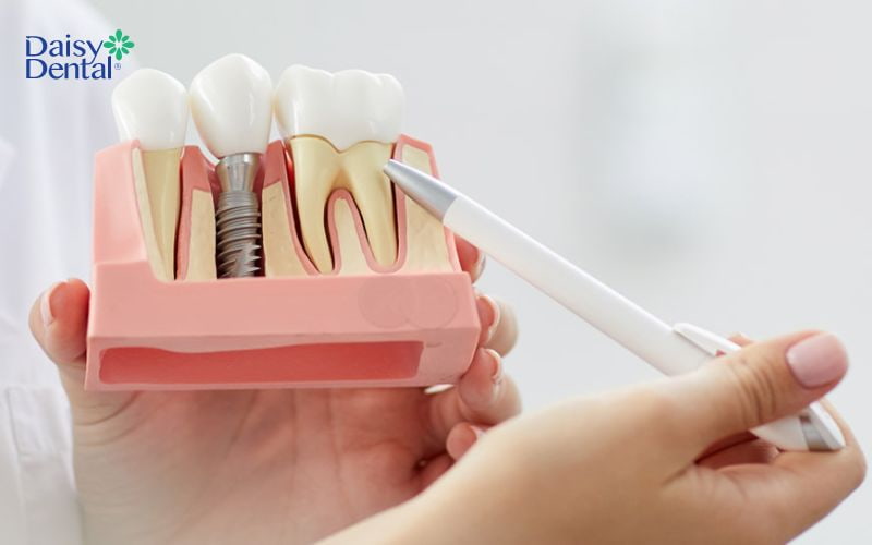 Trồng răng Implant sở hữu nhiều ưu điểm vượt trội so với các giải pháp phục hình răng khác