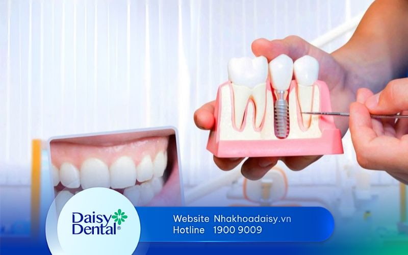 Implant ICX