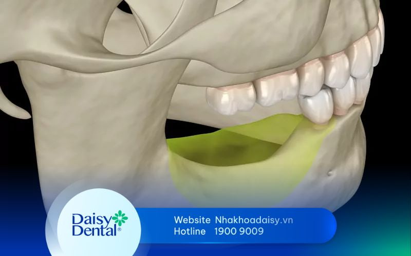 Bị tiêu xương hàm có chữa được không