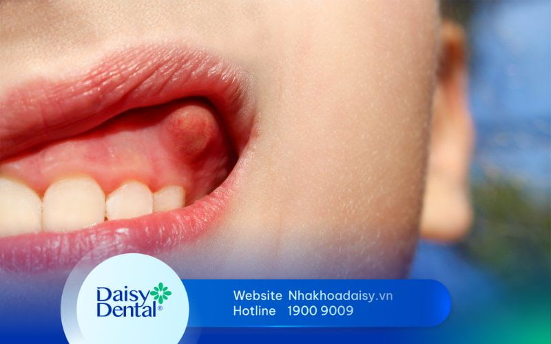 cách chữa sưng mộng răng tại nhà