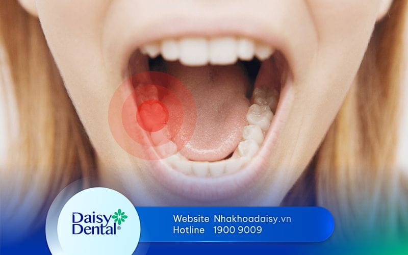 cách làm hết nhức răng nhanh nhất
