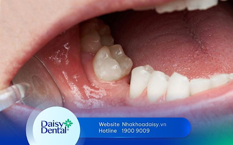 Hậu quả của mất răng số 6 sớm