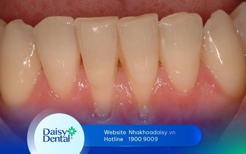 nguyên nhân gây tụt lợi