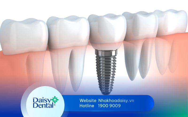 tại sao phải trồng răng Implant
