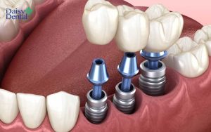 Trồng răng Implant được đánh giá cao về độ bền