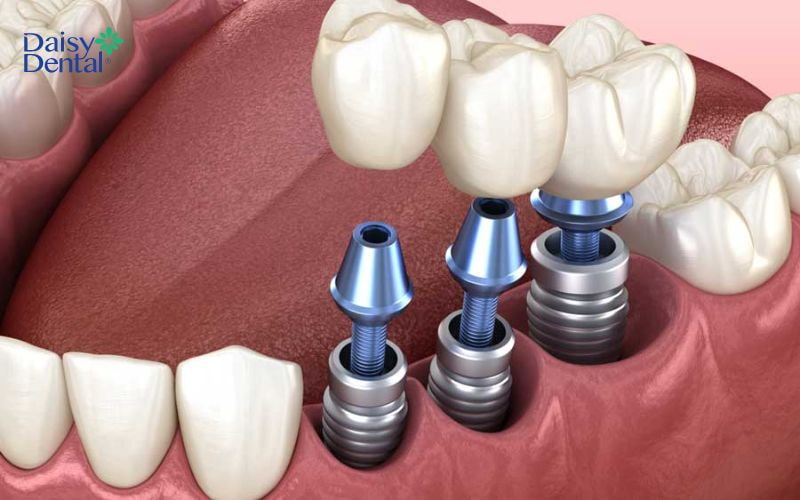 Trồng răng Implant được đánh giá cao về độ bền