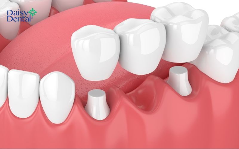 Dãy cầu sứ gồm nhiều răng bằng sứ liền kề