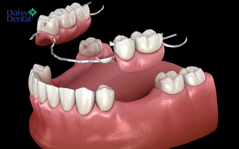 Hàm giả tháo lắp là giải pháp phục hình răng truyền thống với chi phí thấp