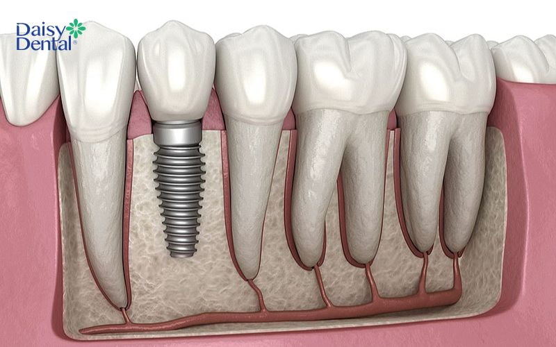 Phương pháp trồng răng cần đảm bảo bảo tồn được các răng thật tối đa