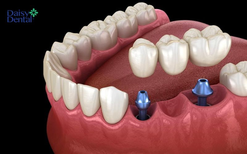 Trồng răng Implant là giải pháp được lựa chọn hàng đầu bởi các chuyên gia