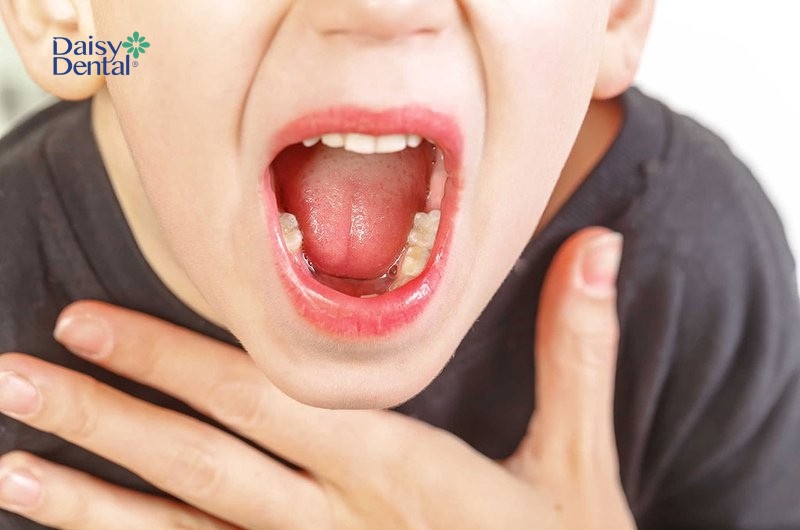 Trẻ nhỏ rất dễ mắc phải bệnh viêm họng, nhất là vào mùa lạnh