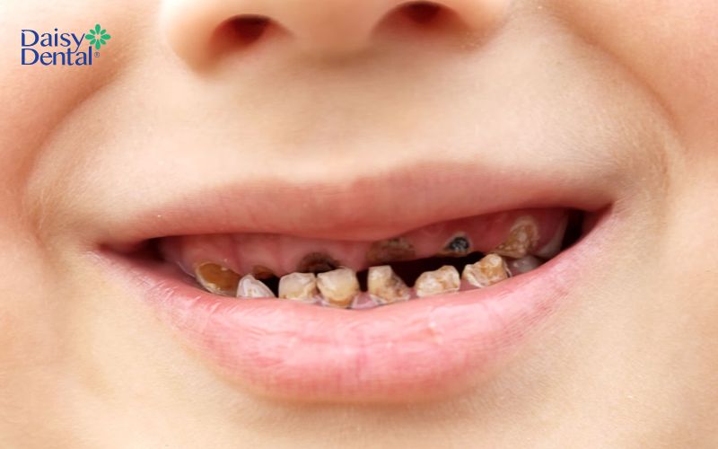 Trẻ em thường dễ bị sâu răng, đây cũng là mối lo chung của các bậc phụ huynh