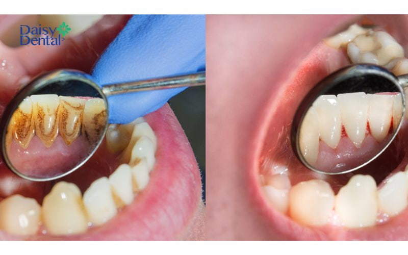 Bạn nên lấy cao răng định kỳ để bảo vệ răng miệng tốt nhất