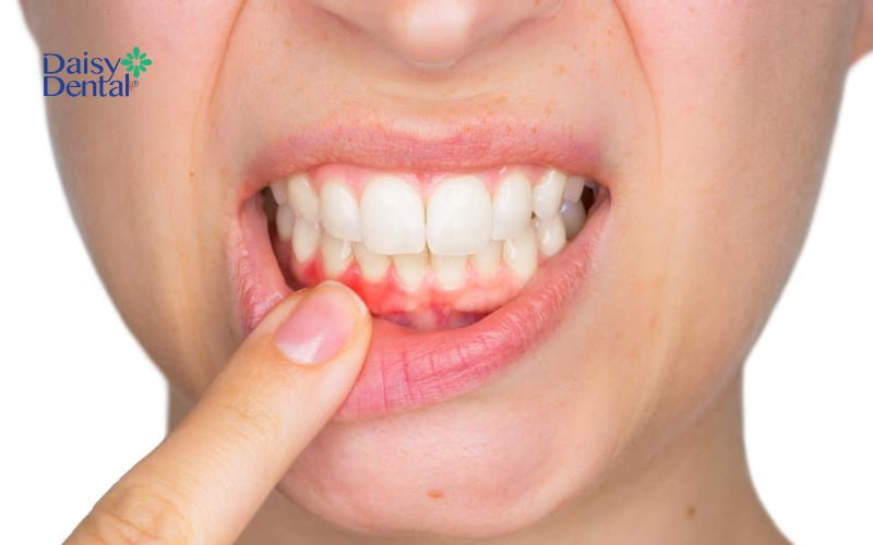 Nướu sưng đỏ, bạn nên thăm khám bác sĩ