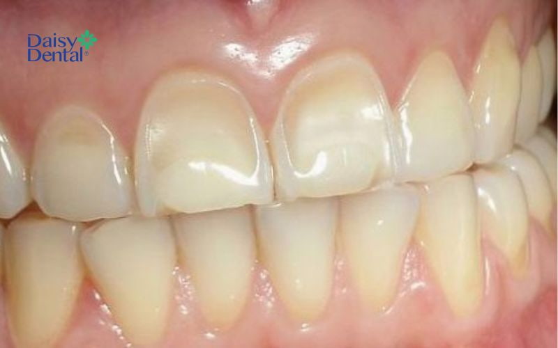 Khi cấu trúc răng bị tổn thương, lớp ngà răng lộ ra ngoài dễ gây nên ê buốt răng