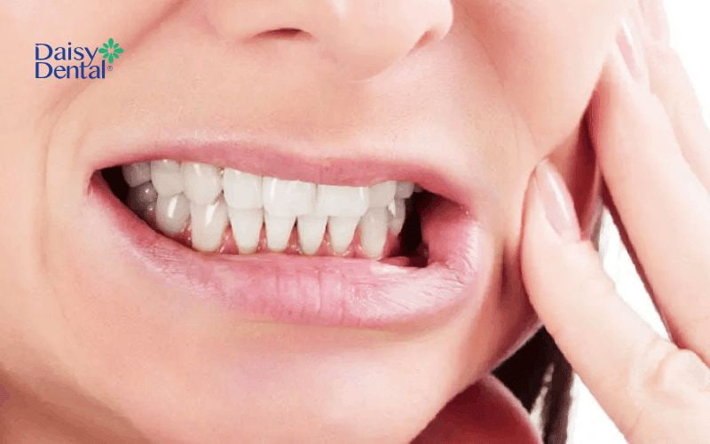 Nghiến răng thường xuyên cũng là nguyên gây khiến bạn bị ê răng cửa hàm trên