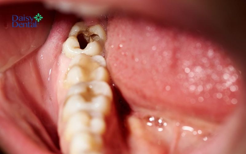 Sâu răng nghiêm trọng khiến răng thường xuyên ê buốt, đau đớn