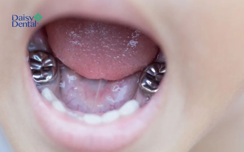 Bọc răng bạc giúp khôi phục chức năng ăn nhai và cải thiện tính thẩm mỹ