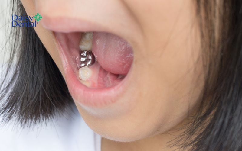 Bọc răng bạc thường được bác sĩ chỉ định cho các răng trong cùng cung hàm