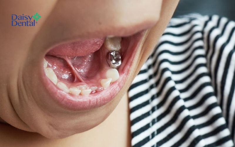 Chi phí bọc răng bạc dao động từ 1.000.000 đến 5.000.000 VNĐ