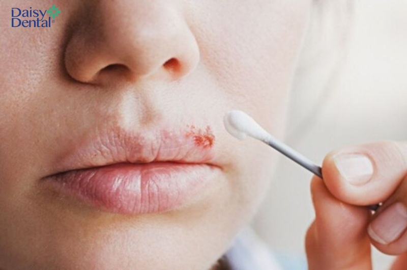 Bạn nên dùng tăm bông để bôi kem khi bị rộp môi