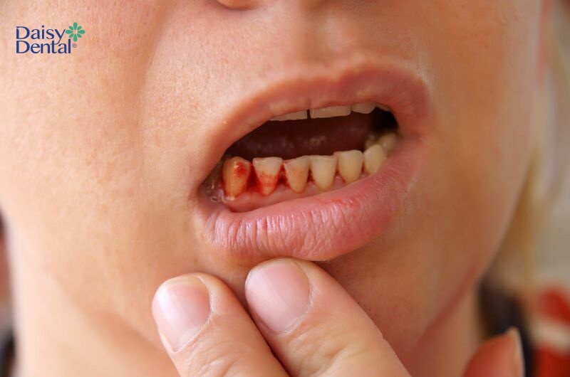 Chảy máu răng khi vừa ngủ dậy có nhiều nguyên nhân khác nhau