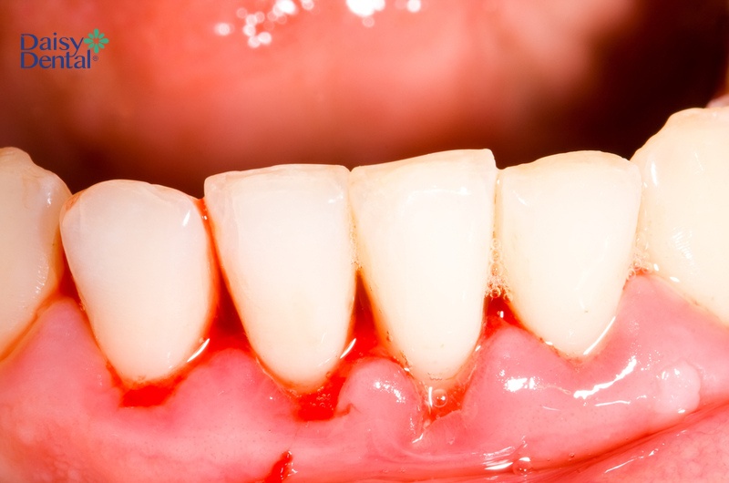 Chảy máu chân răng khi vừa ngủ dậy thường xuyên cũng là dấu hiệu của một số bệnh lý nghiêm trọng khác