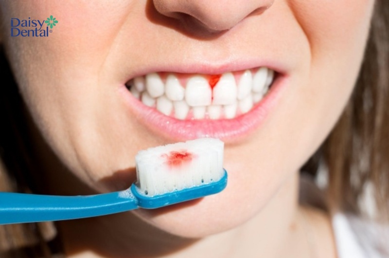 Sử dụng bàn chải có đầu lông cứng cũng dễ gây chảy máu chân răng khi ngủ dậy