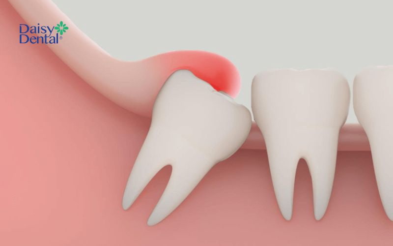 Răng khôn mọc lệch sẽ gây sưng nướu răng