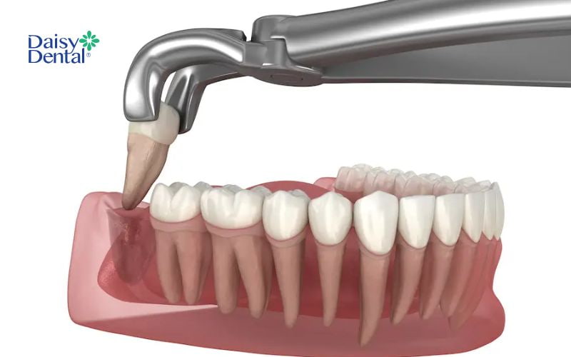 Bác sĩ có thể chỉ định nhổ răng khôn để tránh ảnh hưởng đến răng số 7