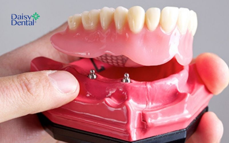 Mô hình minh họa hàm tháo lắp trên Implant