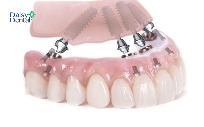 Nhờ các trụ Implant được cấy vào xương hàm thay cho chân răng thật nên cho khả năng ăn nhai tốt