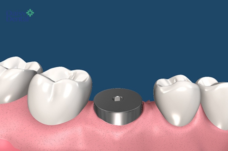 Abutment Healing là khớp nối được lắp trên cổ trụ Implant