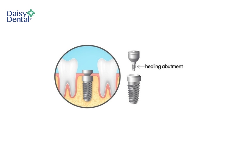 Bộ phận này có vai trò kết nối trụ Implant và môi trường miệng