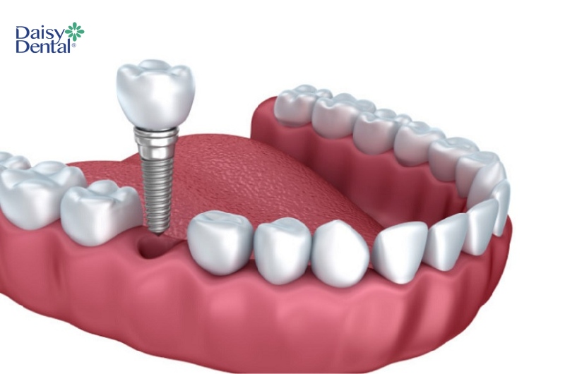 Healing Abutment có thể được đặt ngay sau khi cấy ghép Implant hoặc sau đó vài tháng