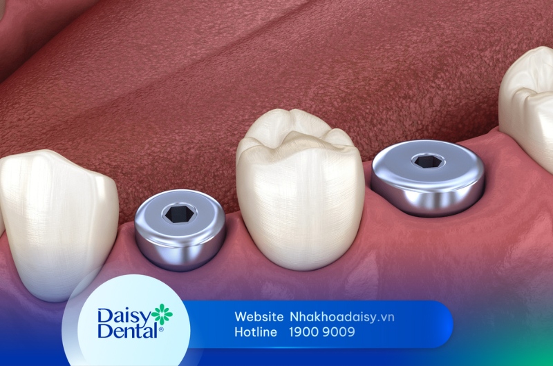 Healing Abutment