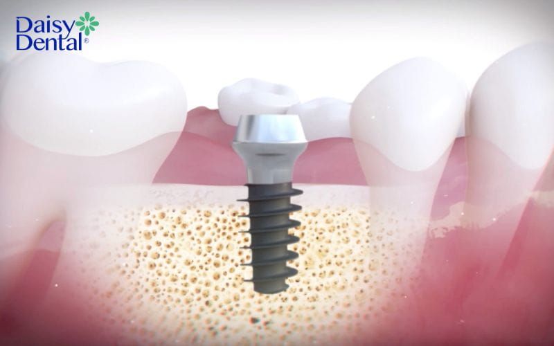 Implant Magicore