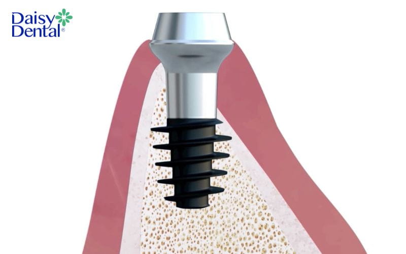 Implant Magicore