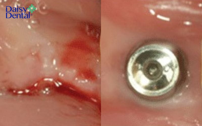 Implant Magicore